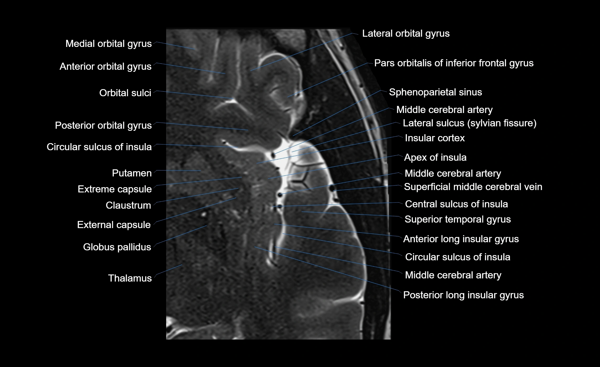 Brain insula axial  anatomy 3T MRI image-img-00001-00007.webp